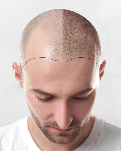 Hair Transplant, DHI SAPPHIRE