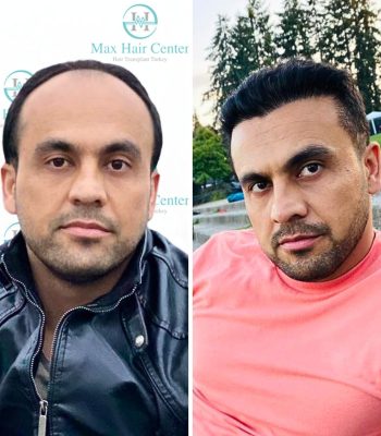 Max hair center, Before and after, DHI hair transplant, Fue Hair transplant, Hair transplant in Turkey, Max Hair Restoration