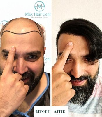 Max hair center, Before and after, DHI hair transplant, Fue Hair transplant, Hair transplant in Turkey, Max Hair Restoration