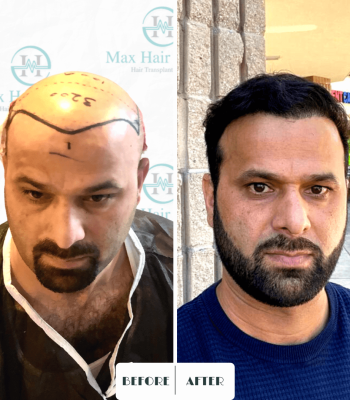 Max Hair trabsplantation, hair restoration turkey 11