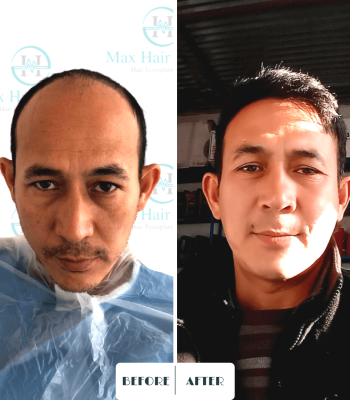 Max Hair trabsplantation, hair restoration turkey 12