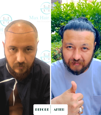 Max Hair trabsplantation, hair restoration turkey 13