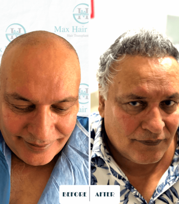 Max Hair trabsplantation, hair restoration turkey 14