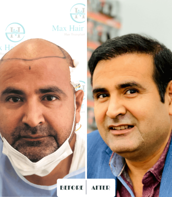 Max Hair trabsplantation, hair restoration turkey 15