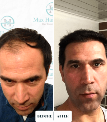 Max Hair trabsplantation, hair restoration turkey 7
