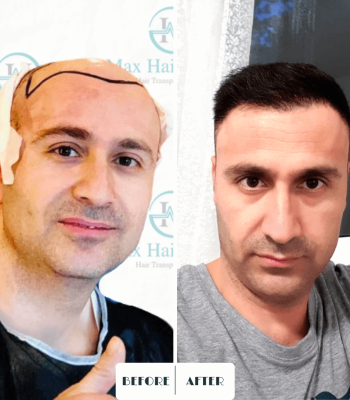 Max Hair trabsplantation, hair restoration turkey 9